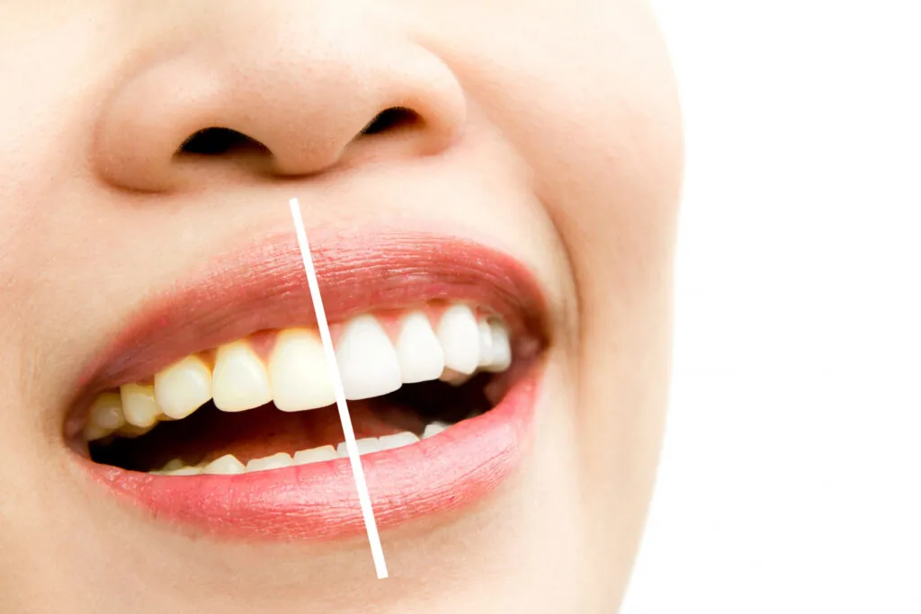 Smile with a line showing the midline of the front teeth